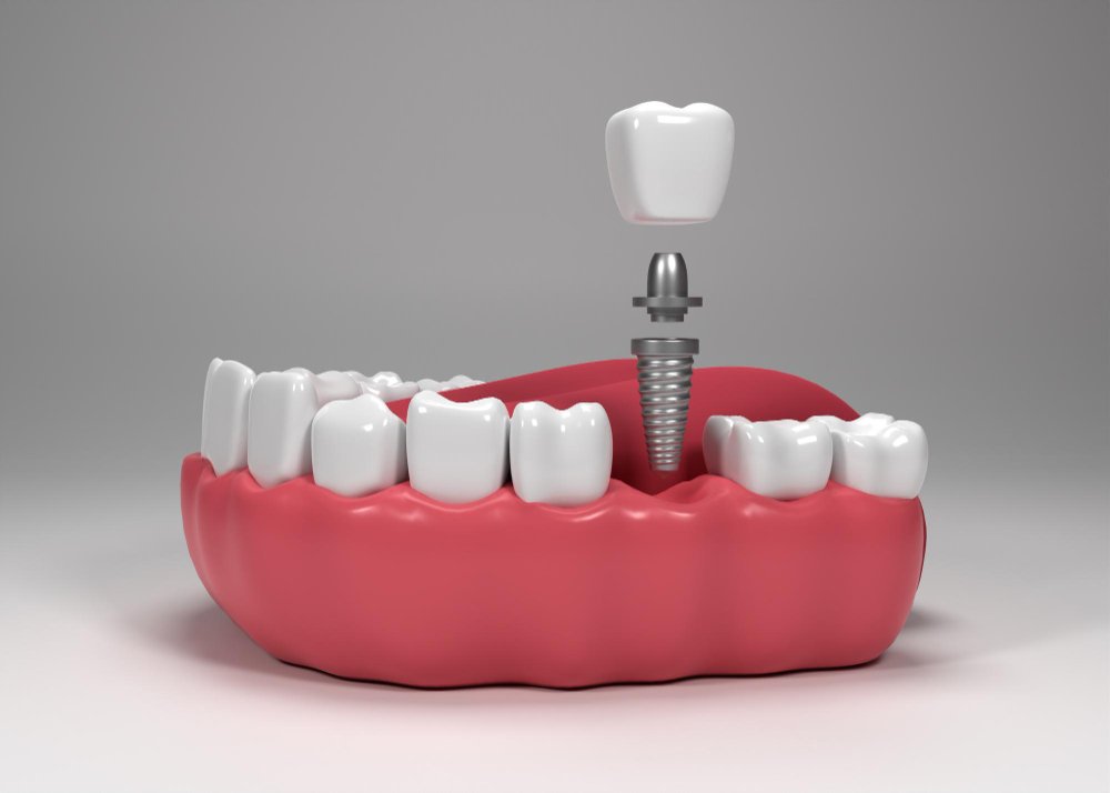 Dental implant care by Dr. Preetika Gupta