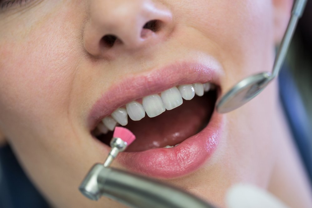 Teeth cleaning and polishing at ARKA Clinic
